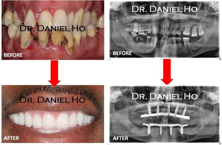 Smile Gallery  North Houston Periodontics & Dental Implants pour Dentist Implants Northwest Houston