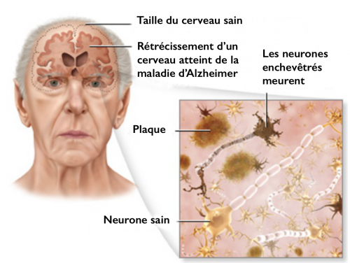 5 Conseils Pour Prévenir La Maladie D'Alzheimer dedans Exercises De Memoire Alzheimer
