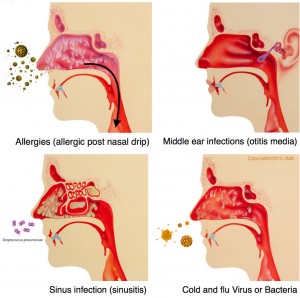 postnasal drip syndrom erfahrungen