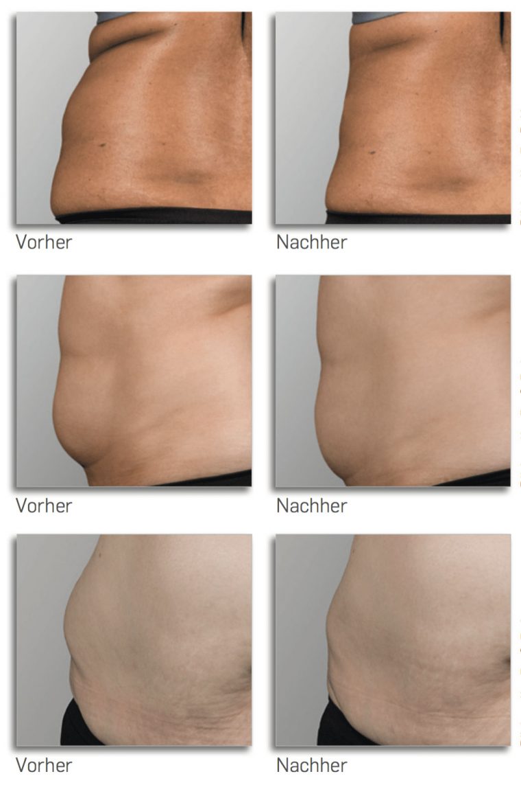 aufgeblähten lipo reparieren