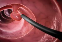 colorectal cancer colonoscopy image colorectal cancer colonoscopy image