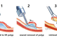 colonoscopy polyp removal colonoscopy polyp removal